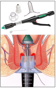 Piles Treatment in Solapur | Piles Doctor in Solapur