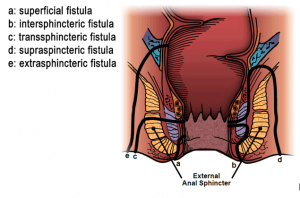 Fistula Treatment in Solapur | Fistula Surgery In Solapur