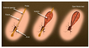 Fistula Treatment in Solapur | Fistula Surgery In Solapur
