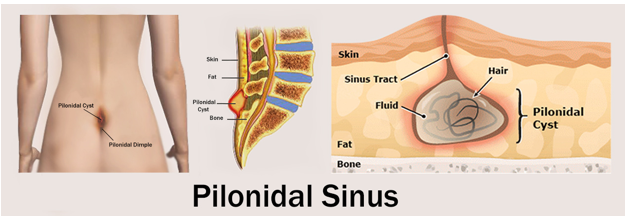 Pilonidal disease - Wikipedia