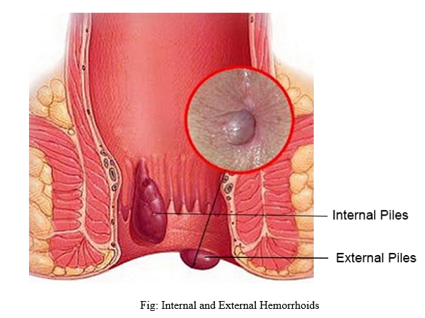 Piles Doctor in Baramati, Piles Treatment in Baramati, Best Piles  specialists in Baramati