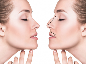 Rhinoplasty surgery in Solapur | Rhinoplasty in Solapur