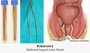 Fistula Treatment in Solapur | Fistula Surgery In Solapur