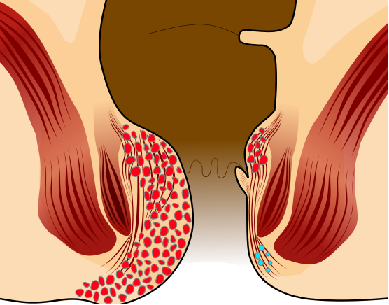 Treatment for Piles in Satara | Laser treatment for piles | Piles Clinic in Satara | Piles laser treatment | Piles treatment Treatment for Piles in Satara | Laser treatment for piles | Piles Clinic in Satara | Piles laser treatment | Piles treatment